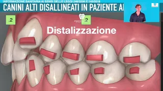 Canini alti e storti e seconda classe NO ESTRAZIONI in ragazza: allineatori trasparenti, come fare?