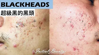 超級黑的粉刺(SUPER BLACK blackheads) - Taiwan Tainan台南清粉刺最乾淨