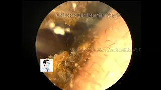 Ear wax removing,Cerumen and fungus cleaning,11mins,20220915