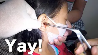 Huge Cockroach STUCK in Girl's Ear | How It's Removed