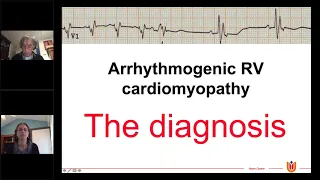 Evaluation, Risk Stratification, and Management of Arrhythmogenic Cardiomyopathy