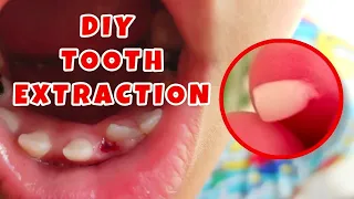 Baby tooth extraction at home  | Teeth pulling method | Easy extract baby teeth