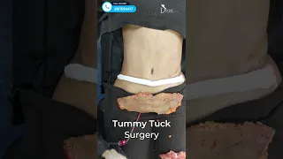 Tummy Tuck Surgery | Immediate Before and After Results #shortsfeed