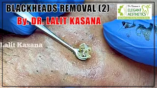 THE BEST BLACKHEADS REMOVAL BY DR. LALIT KASANA PART 2 | BLACKHEADS | DR. LALIT KASANA | PART 2