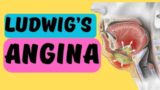 Ludwig's Angina | Explained in 2 minutes! Signs, Symptoms and Treatment | Angina Ludovici