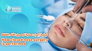 rhinoplasty #rhinoplasty #nosejob #cosmeticsurgery #nosejobbeforeandafter