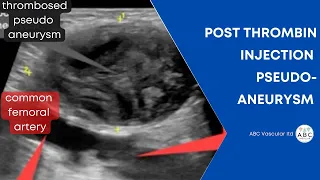 A thrombosed Common femoral artery pseudoaneurysm: ultrasound features