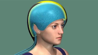 Scalp Cooling: New Technology Eliminates Hair Loss from Chemotherapy