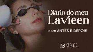 TESTEI o LASER LAVIEEN! Dói muito? Descama a pele? Com ANTES e DEPOIS