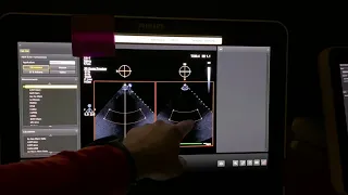 How to acquire a 3D zoom echocardiogram image on a Phillips EPIQ machine