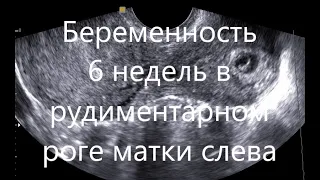 Беременность 6 недель в рудиментарном роге матки слева