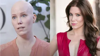 An Actress/Model's Journey Through Alopecia, Hair loss, and Self-love | Dimples Stories
