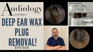 DEEP EAR WAX PLUG REMOVAL - EP649