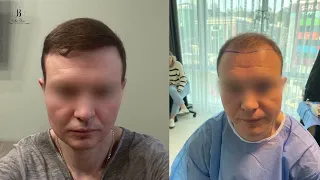 Hair transplant result after 1 year -  FUE 4800 grafts