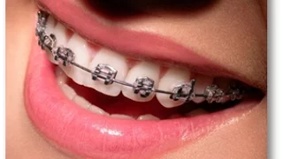 Esto es lo que debes de saber ANTES de ponerte brackets, frenos, dentales u Ortodoncia.