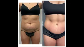 Tummy tuck patient ready for summer ☀️