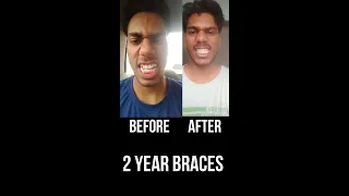 Braces Before and After | Reshaping of teeth | Teeth Before and after Transformation #shorts