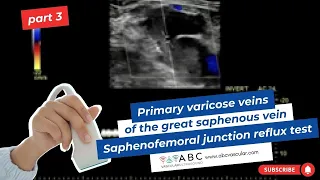 Part 3: Primary varicose veins of the great saphenous vein. Saphenofemoral junction reflux test