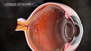 Posterior Vitreous Detachment - PVD