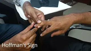 Hoffman's Sign with dr mohsin || how to check Hoffman's Sign in real patient