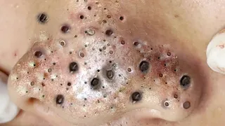 Blackheads Extraction Whiteheads Removal Pimple Popping #2823