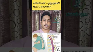 சிசேரியன் செய்த பின்பு முதுகுவலி ஏற்பட காரணம்|Post caesarean back pain|Post Spinal backache|Backpain