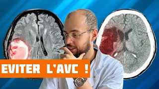 Comment prévenir l’Accident Vasculaire Cérébral ?