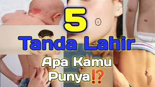 Cek yuukk..Apa kamu punya? |5 tanda lahir #mitos#tandalahir