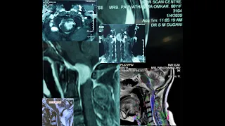 FORAMENA MAGNUM MENINGIOMA-FAR POSTERO LATERAL APPROACH-MICROSURGERY-dr suresh dugani/HUBBALLI/INDIA