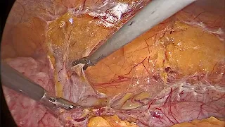 2022 10 18 Laparoscopic Right Nephrectomy / Лапароскопическая нефрэктомия справа