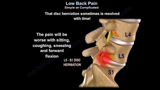 Low Back Pain Simple or Complicated - Everything You Need To Know - Dr. Nabil Ebraheim