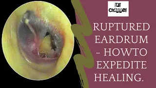 Ruptured eardrum I what should you do after traumatic perforation of tympanic membrane?