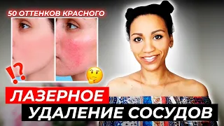 Правда про лазерное удаление сосудов//Удалить сосудистые звёздочки (купероз) и сосудистую сетку