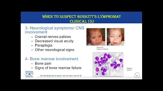 Diagnosis and Referral of Burkitt’s Lymphoma – 3 February 2023