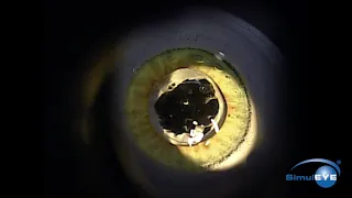 SimulEYE YAG Capsulotomy