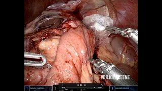 Robotic Roux-en-Y Gastric Bypass (RYGB) Revision for Gastrogastric Fistula