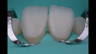 Isolamento absoluto e cimentação  lentes de contato cerâmicas (Facetas).