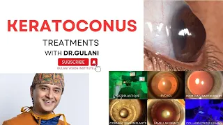 #keratoconus Correction: #americanacademyofophthalmology  & Dr. Gulani: Correcting Keratoconus