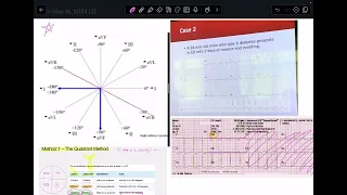 Easy How to: Axis Deviation on 12 EKG