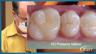 Herculite Ultra Anterior Restoration