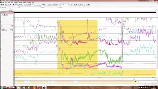 How to Analyze a pH-Impedance tracing ESNM teaching video