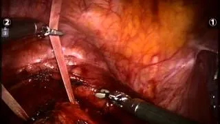 Robotic Assisted Cerclage by Dr. Marc Winter