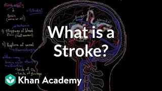 What is a stroke? | Circulatory System and Disease | NCLEX-RN | Khan Academy
