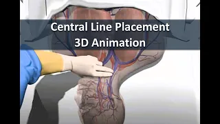 Learn about Central Line Placement with 3D animation