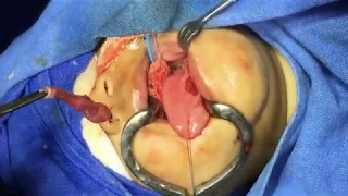 Ranula Excision & Marsupialization