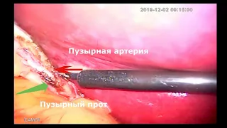 Лапароскопическая холецистэктомия. Laparoscopic cholecystectomy full time video