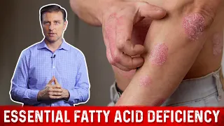 Fatty Acids (Omega-3 and Omega-6) Deficiency: Symptoms and Sources by Dr.Berg