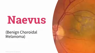 Naevus benign choroidal melanoma