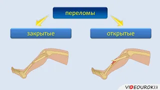 13  Первая помощь при ушибах, растяжениях, вывихах и переломах