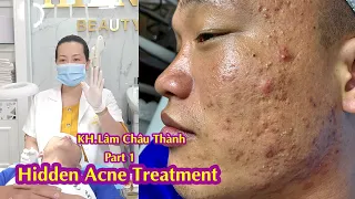 Hidden Cystic Acne I Điều trị ẩn hiệu quả số 1 tại Hiền Vân Spa I Lâm Châu Thành I 507